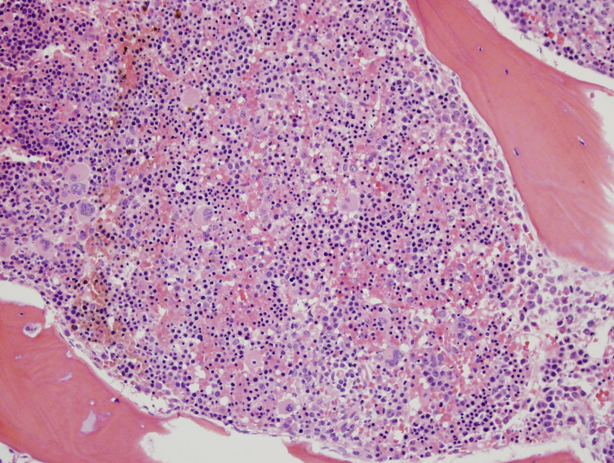 Bone Marrow Biopsy, H & E, 20X